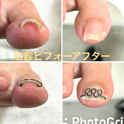 巻き爪矯正「ツメフラ法」のイメージ